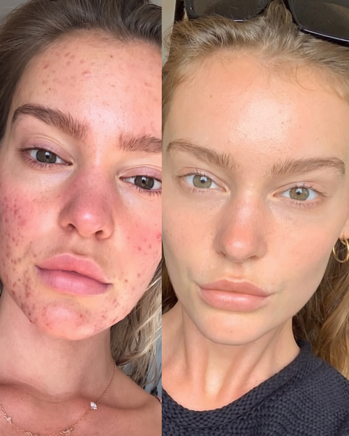 Prima e dopo cicatrici da acne