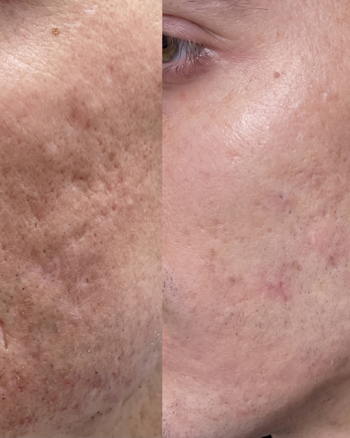 Prima e dopo cicatrici da acne