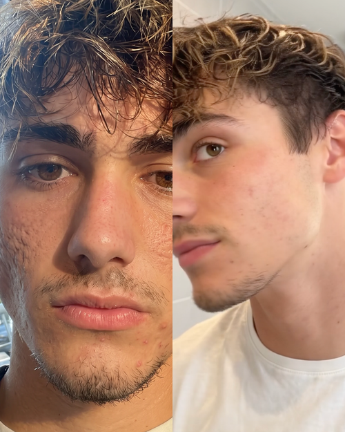 Prima e dopo cicatrici da acne