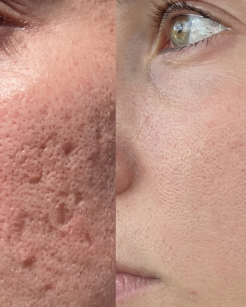 Prima e dopo cicatrici da acne