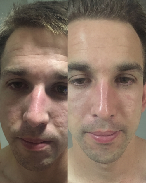Prima e dopo cicatrici da acne