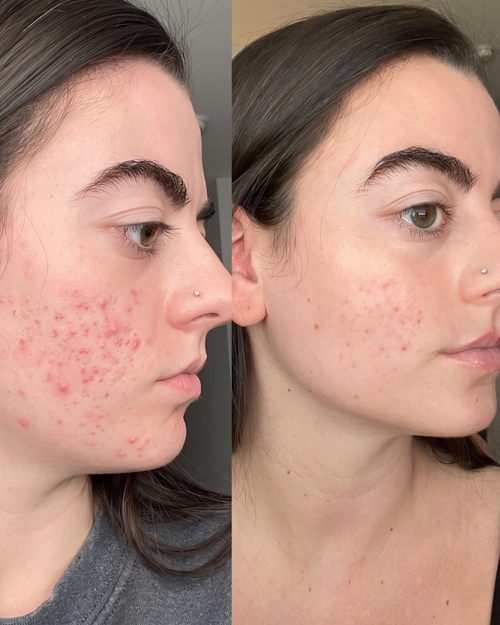 Prima e dopo cicatrici da acne