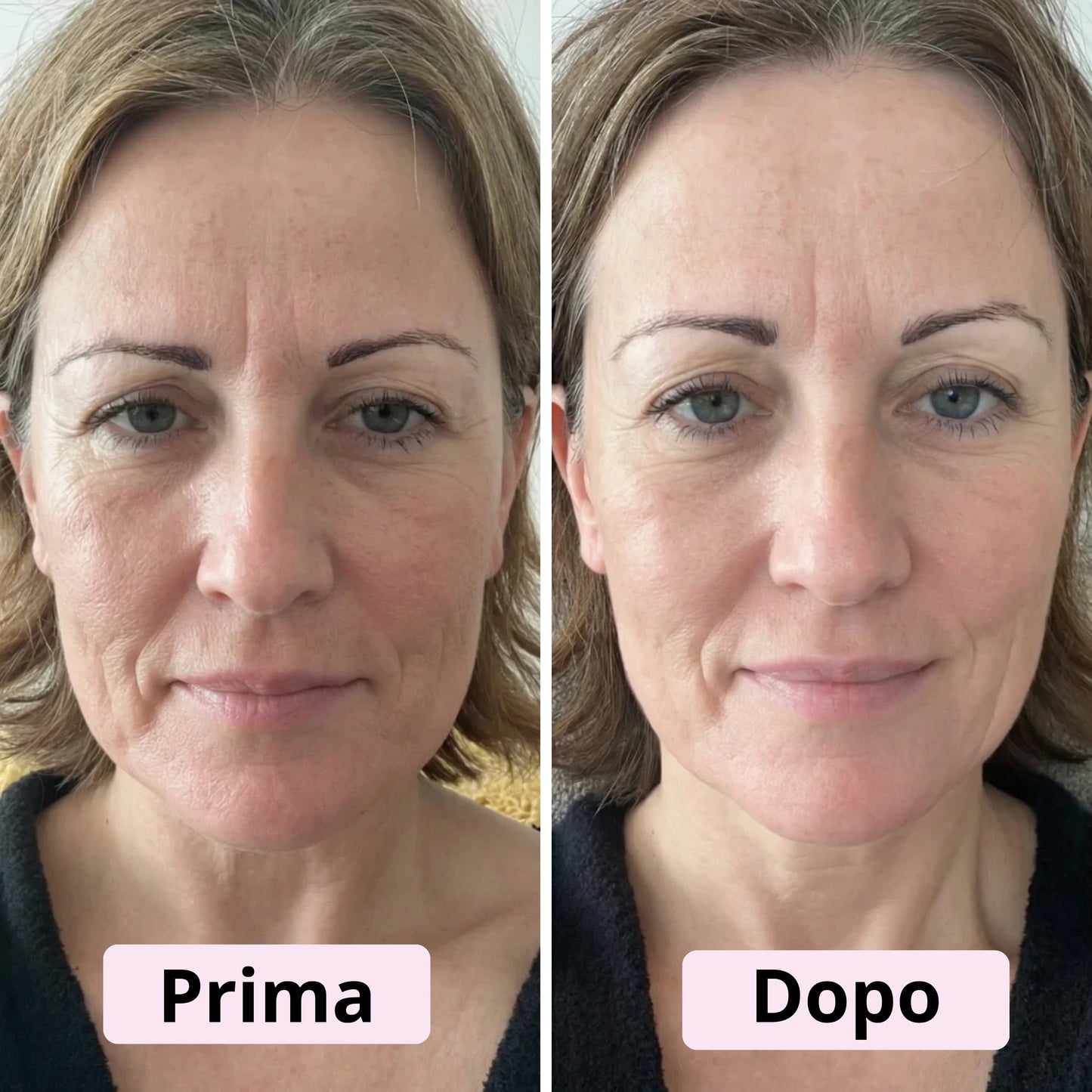 Siero in Capsule al PDRN e Acido Ialuronico