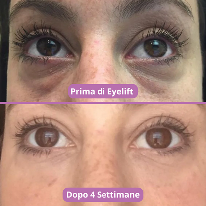 Elvrea Eye Lift