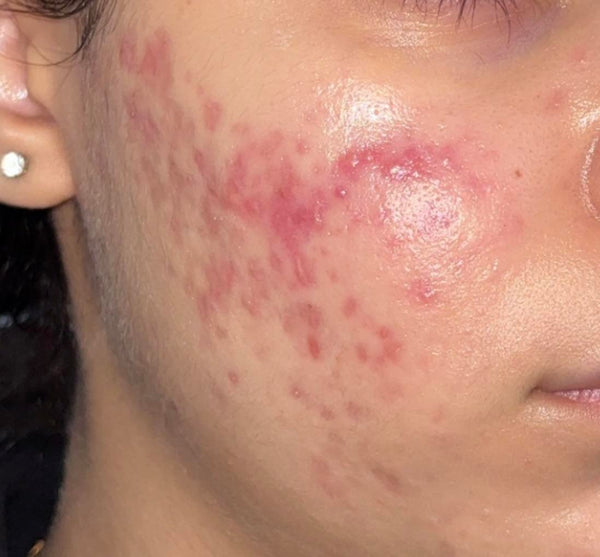 Macchie Rosse o Scure Post-Acne