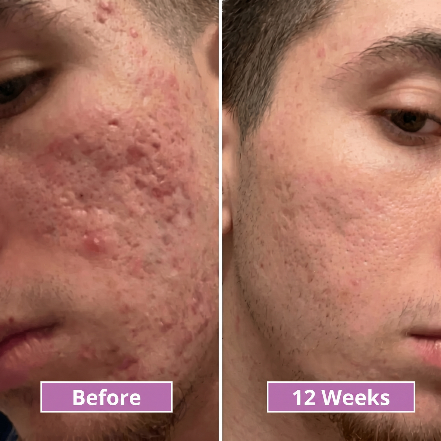 Acne Scar Invisible Repair Barrier