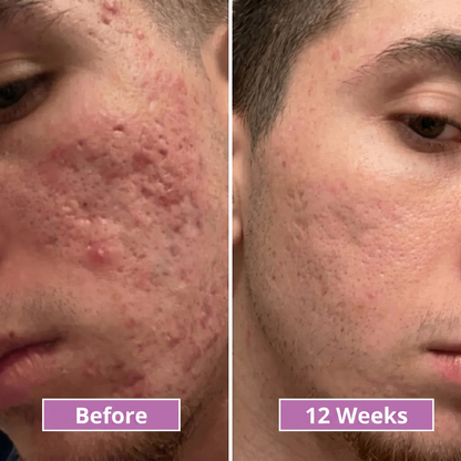 Acne Scar Invisible Repair Barrier